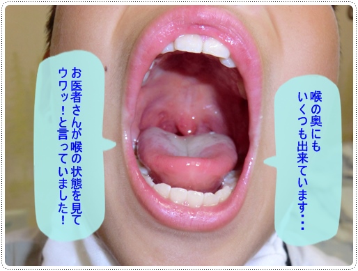 口内炎 病 手足 口 手足口病で口内炎だけの場合はある？口の中だけや口の周りは？